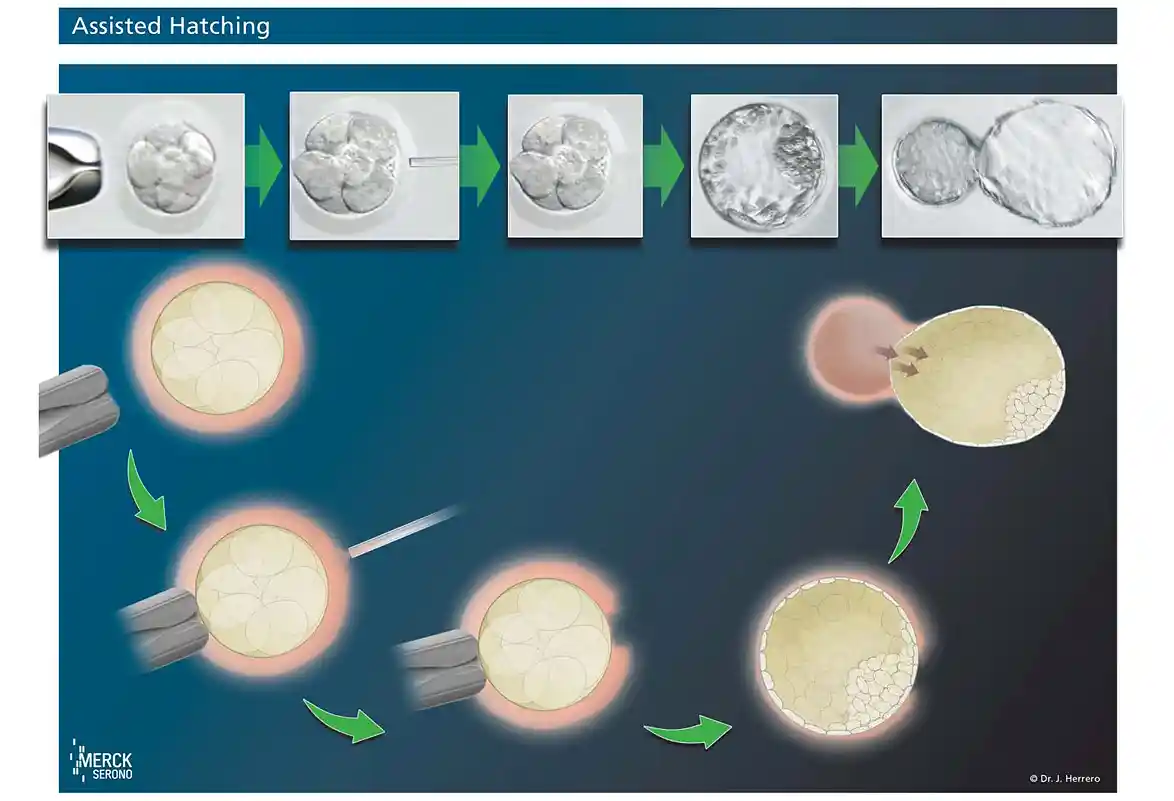 Assisted Hatching | Kinderwunschzentrum Stuttgart